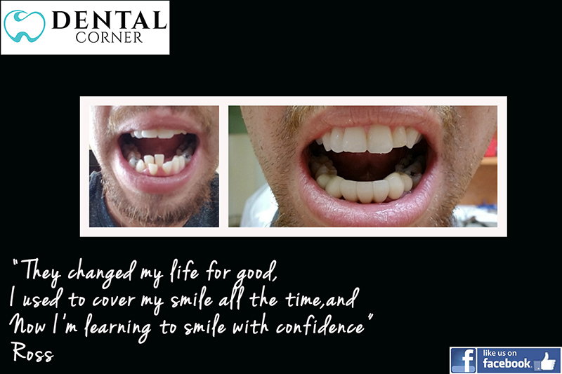 before and after example of Ross, a patient of Dental Corner who received dental restoration treatments