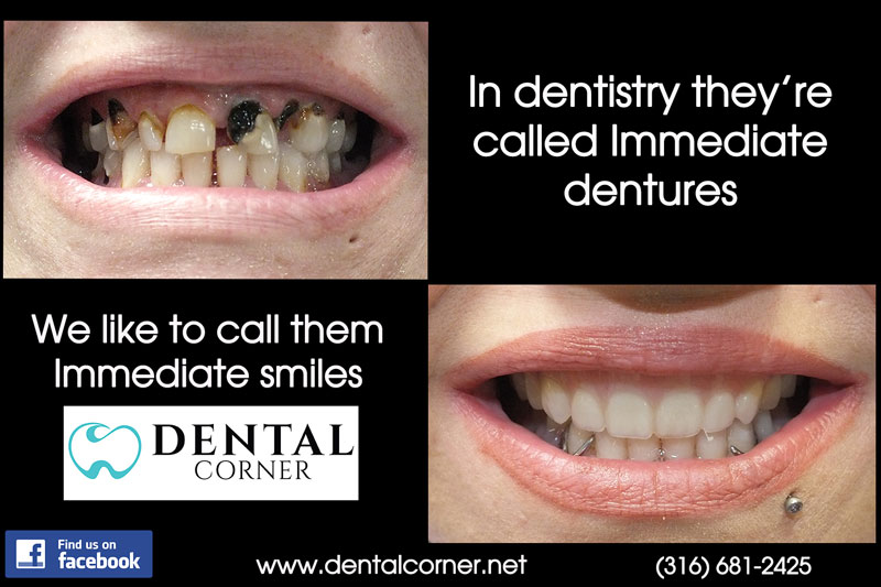 before and after example of a full dental restoration from Dental Corner in Wichita, KS