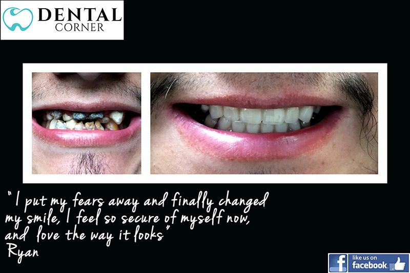 before and after example of Ryan, a patient of Dental Corner who received dental restoration treatments